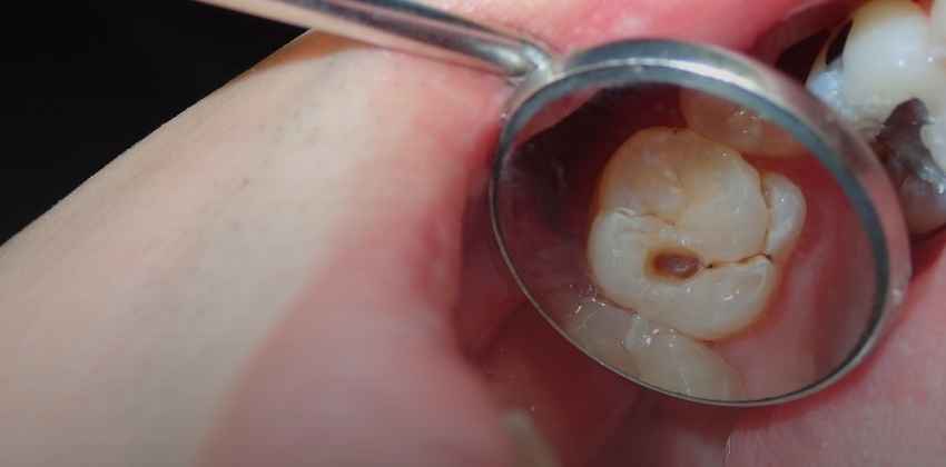 Não Adie o Tratamento da Cárie! Cuide do Seu Sorriso Hoje Mesmo