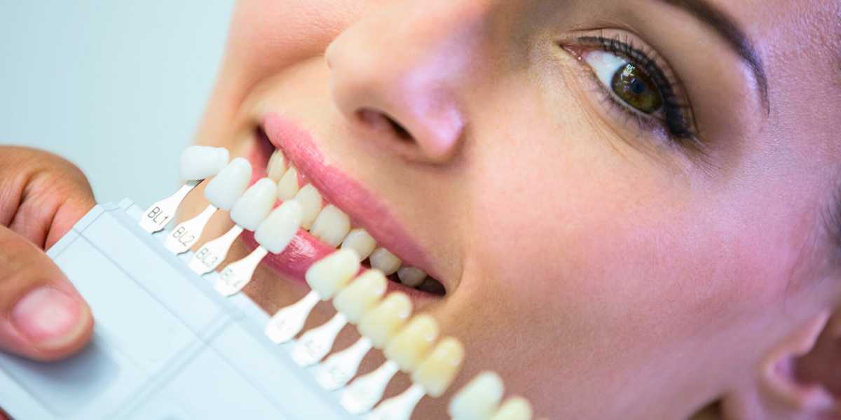 Facetas de porcelana