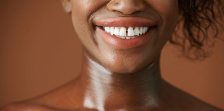 Dentes separados: causas e soluções para o sorriso perfeito