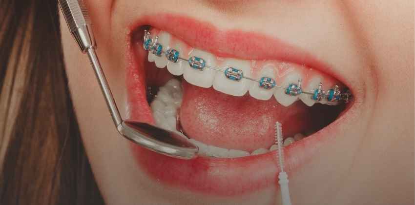 Dentes Tortos? Chegou a Hora de Colocar Aparelho nos Dentes?