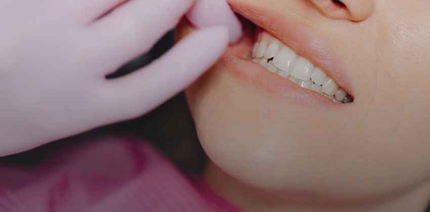 É Verdade que o Siso Pode Entortar os Outros Dentes?