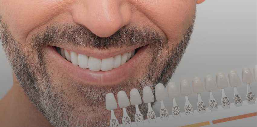 Faceta Dental: Como Funciona? Saiba Mais Aqui!