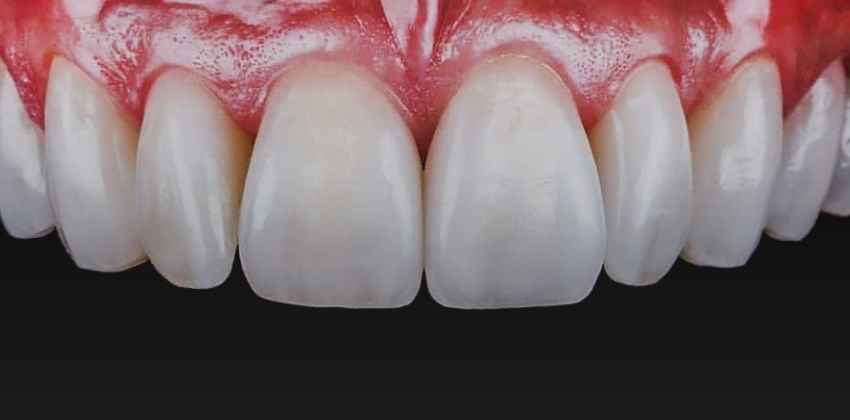 Facetas em Resina: Sorriso Renovado com Estética e Funcionalidade