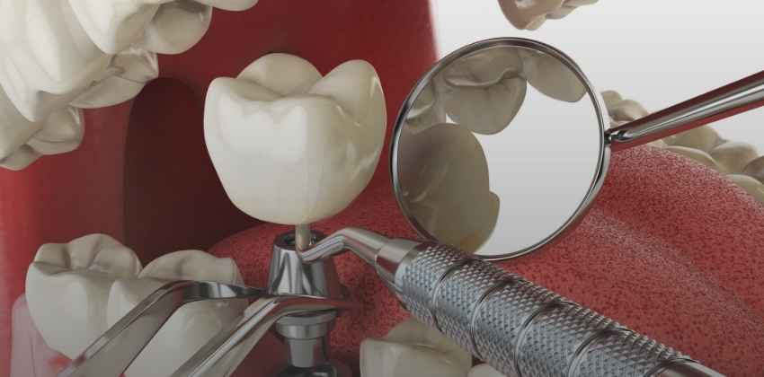 Implante Dentário: O que é, benefícios e cuidados para um sorriso perfeito