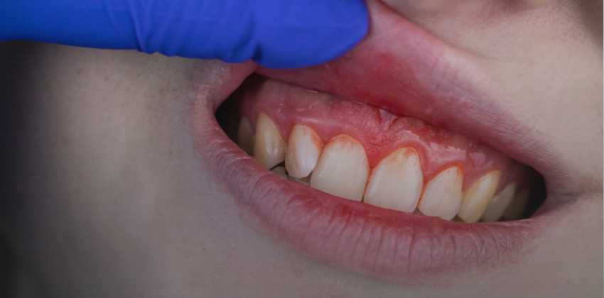 O Que É Periodontia Na Odontologia?