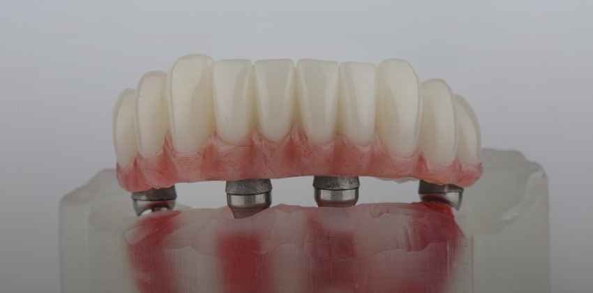 Prótese Protocolo: A Solução Fixa para Recuperar Seu Sorriso