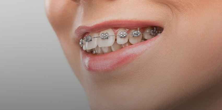 Qual a Melhor Idade para Colocar Aparelho Ortodôntico? Saiba Quando Começar