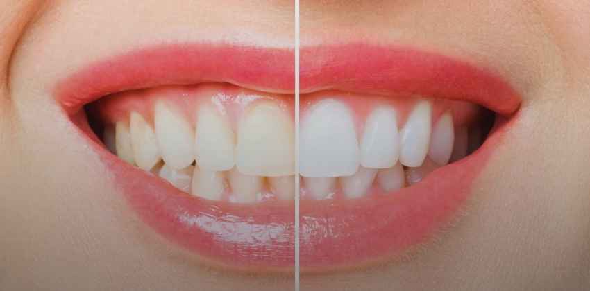 Seu Sorriso Incrível Através do Clareamento Dental