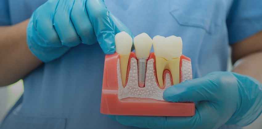 Tratamento de Canal: Como Pode Ajudar Você a Salvar Seu Dente