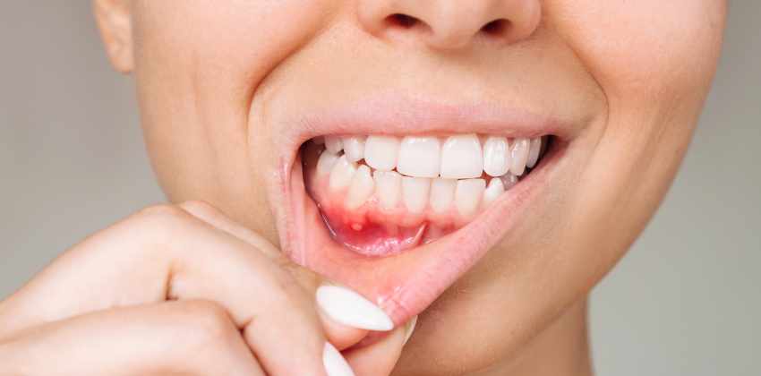 Gengivite x Periodontite: Qual a Diferença e Por Que Preocupar-se?